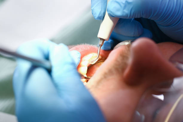 Best Urgent Care for Lost Fillings or Crowns in Miami Shores, FL