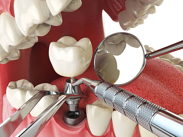 Best Emergency Root Canal Treatment in Miami Shores, FL
